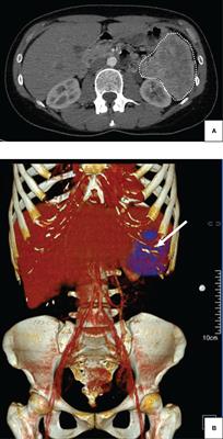 Case Report: Giant insulinoma, a very rare tumor causing hypoglycemia